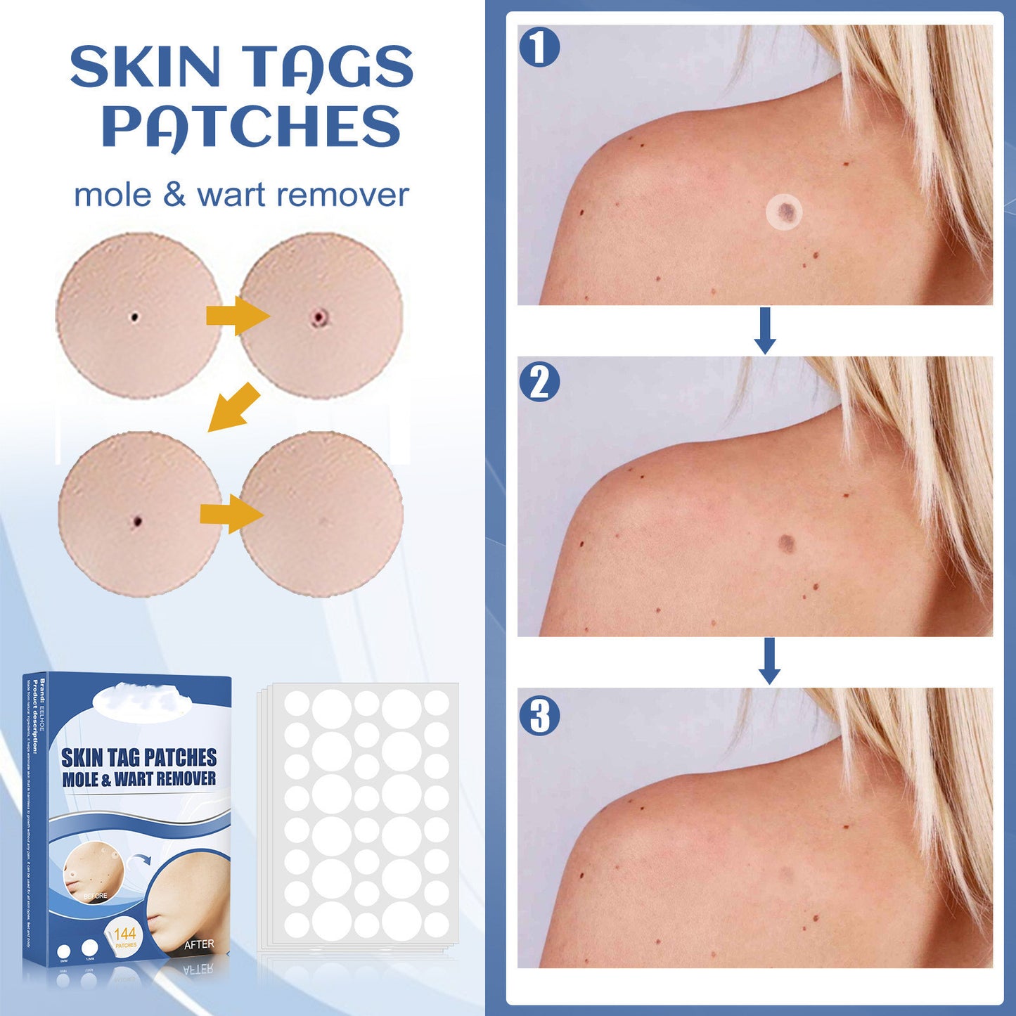 Ke Wart Patch Skin Mole Cleaning Care