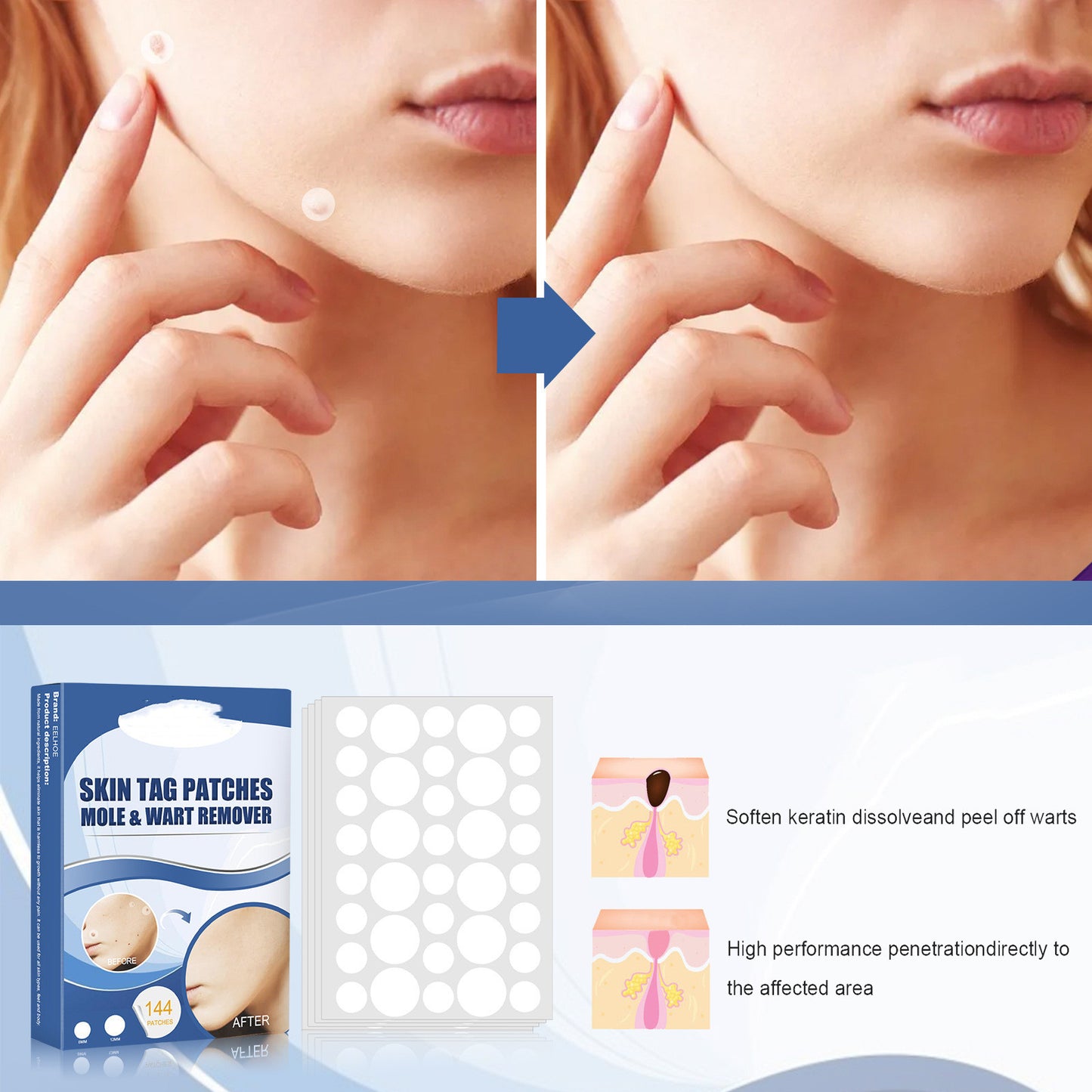 Ke Wart Patch Skin Mole Cleaning Care