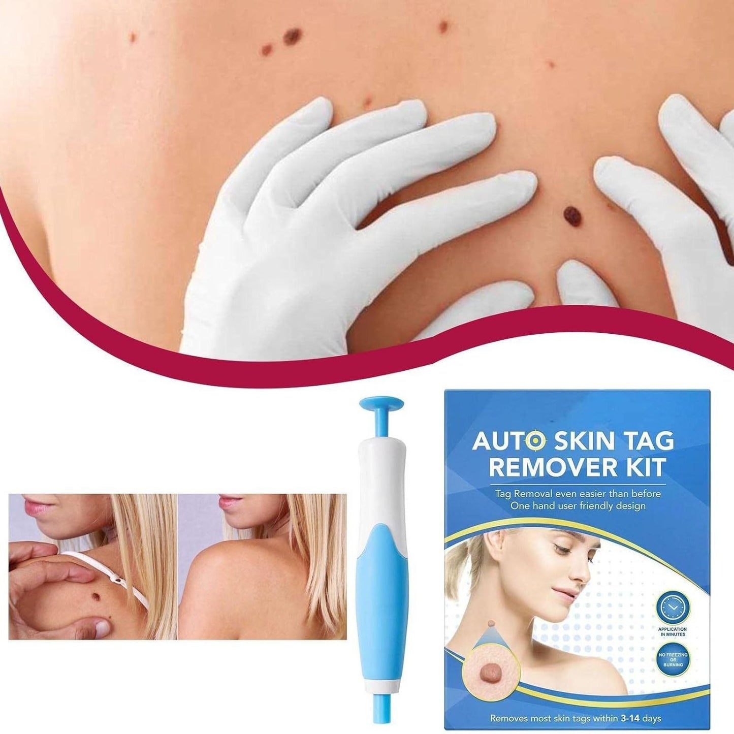 Skin-removing Pen Meat-removing Mole-removing Wart-removing Device 2-generation Boxed